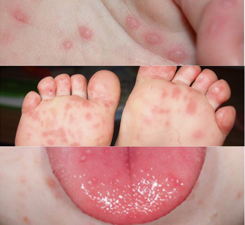 Bệnh tay chân miệng có 4 cấp độ